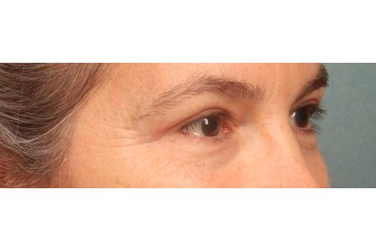 Blepharoplasty Before & After Patient #9671