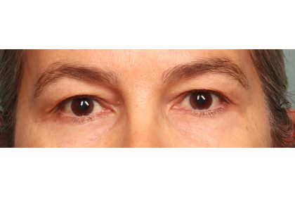 Blepharoplasty Before & After Patient #9671