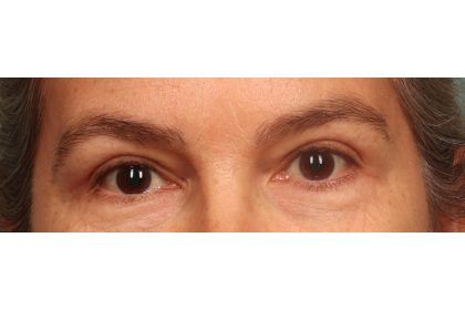 Blepharoplasty Before & After Patient #9671
