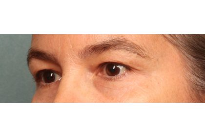 Blepharoplasty Before & After Patient #9671