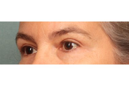 Blepharoplasty Before & After Patient #9671