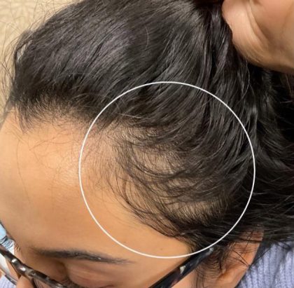 Hair Restoration Before & After Patient #9849