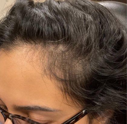 Hair Restoration Before & After Patient #9849