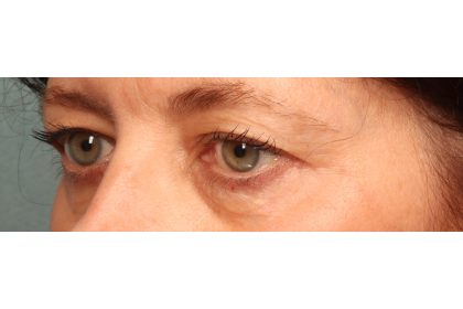 Blepharoplasty Before & After Patient #9819