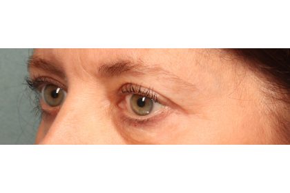 Blepharoplasty Before & After Patient #9819
