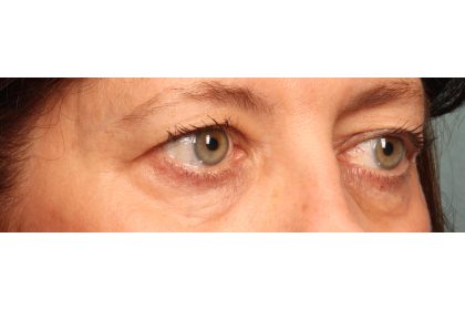 Blepharoplasty Before & After Patient #9819