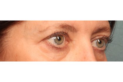 Blepharoplasty Before & After Patient #9819