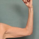 Arm Lift Before & After Patient #9910