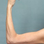 Arm Lift Before & After Patient #9910