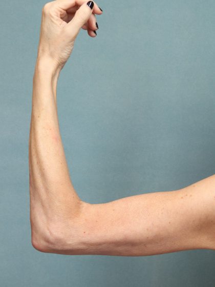 Arm Lift Before & After Patient #9910