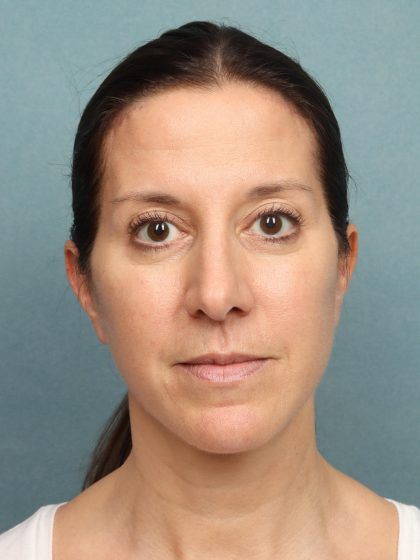 Neck Lift Before & After Patient #9912