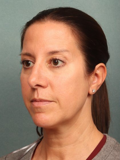 Neck Lift Before & After Patient #9912