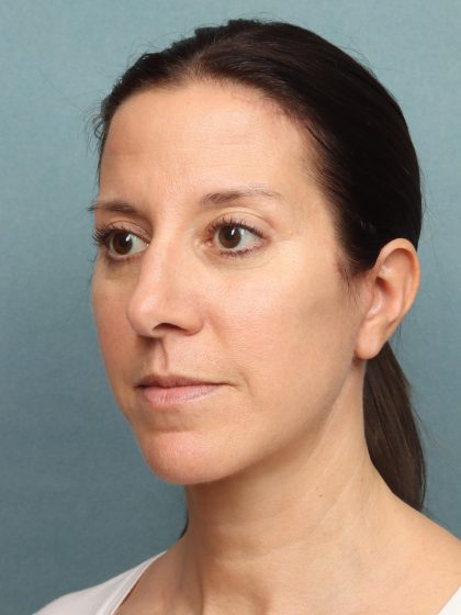 Neck Lift Before & After Patient #9912