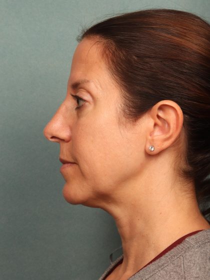 Neck Lift Before & After Patient #9912