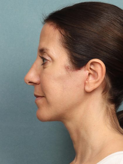 Neck Lift Before & After Patient #9912