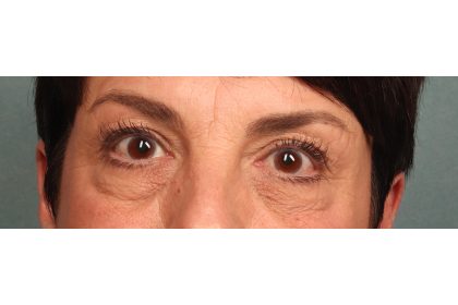 Blepharoplasty Before & After Patient #9879