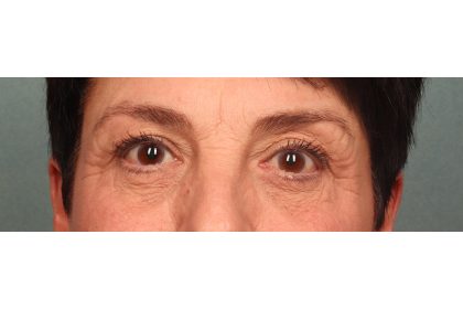 Blepharoplasty Before & After Patient #9879