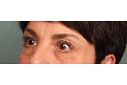Blepharoplasty Before & After Patient #9879