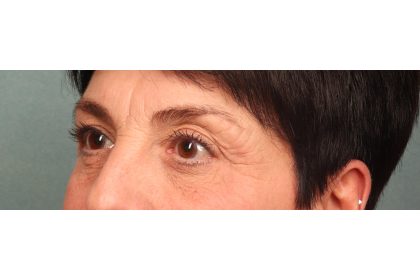 Blepharoplasty Before & After Patient #9879