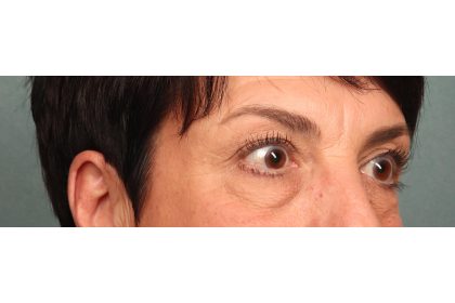 Blepharoplasty Before & After Patient #9879