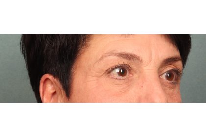 Blepharoplasty Before & After Patient #9879