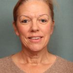 Blepharoplasty Before & After Patient #9987