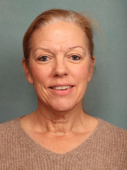 Facelift Before & After Patient #9985