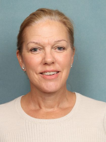 Facelift Before & After Patient #9985