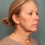 Blepharoplasty Before & After Patient #9987