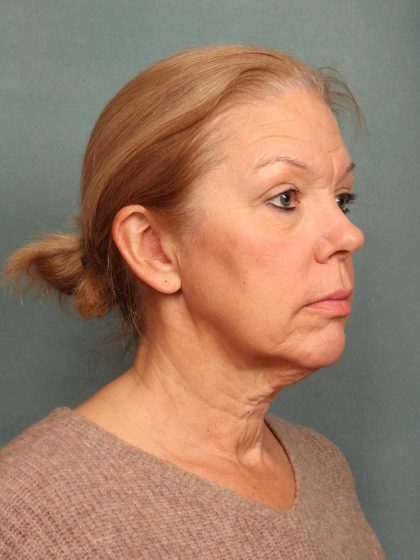 Blepharoplasty Before & After Patient #9987