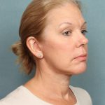 Blepharoplasty Before & After Patient #9987