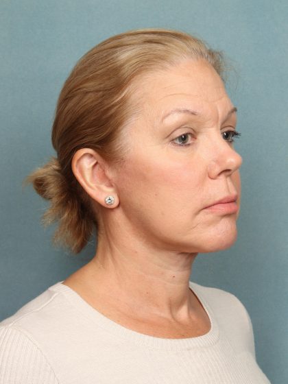 Blepharoplasty Before & After Patient #9987