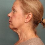 Blepharoplasty Before & After Patient #9987