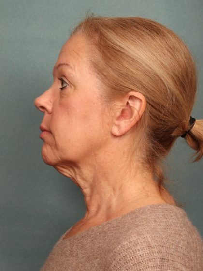 Blepharoplasty Before & After Patient #9987
