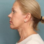 Blepharoplasty Before & After Patient #9987