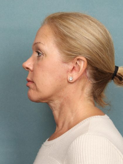 Blepharoplasty Before & After Patient #9987