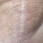 Scar & Stretch Mark Treatment Before & After Patient #10100
