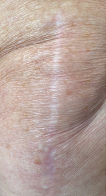 Scar & Stretch Mark Treatment Before & After Patient #10100