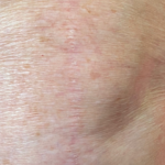 Scar & Stretch Mark Treatment Before & After Patient #10100