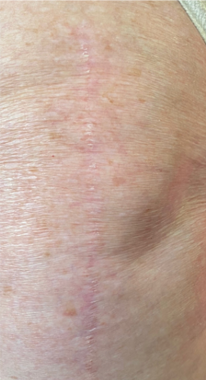 Scar & Stretch Mark Treatment Before & After Patient #10100