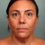 Blepharoplasty Before & After Patient #10032