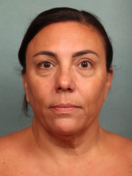 Blepharoplasty Before & After Patient #10032