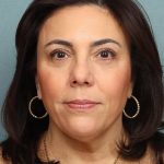Blepharoplasty Before & After Patient #10032