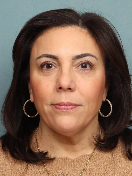 Blepharoplasty Before & After Patient #10032