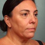 Blepharoplasty Before & After Patient #10032