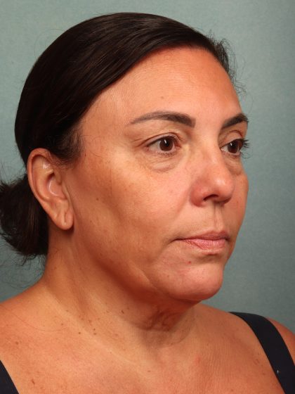 Blepharoplasty Before & After Patient #10032