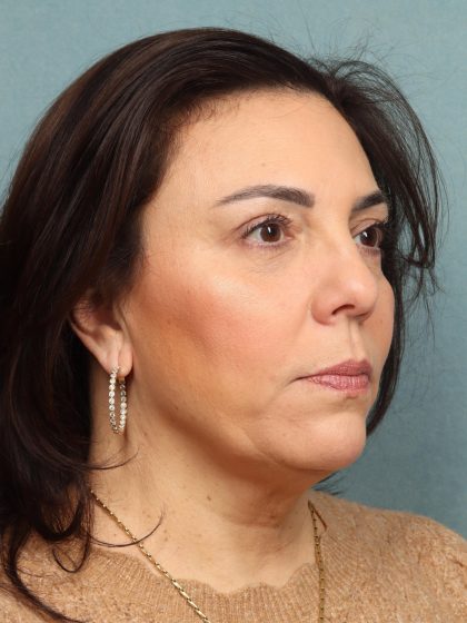 Blepharoplasty Before & After Patient #10032