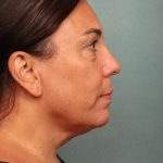 Blepharoplasty Before & After Patient #10032