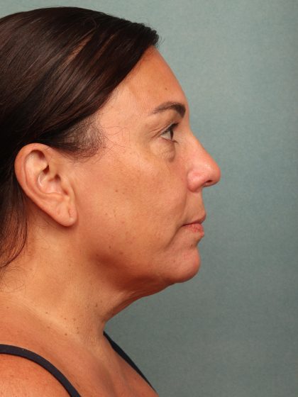 Blepharoplasty Before & After Patient #10032