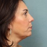Blepharoplasty Before & After Patient #10032